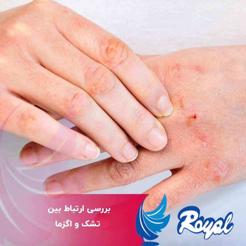 ارتباط بین تشک و اگزما