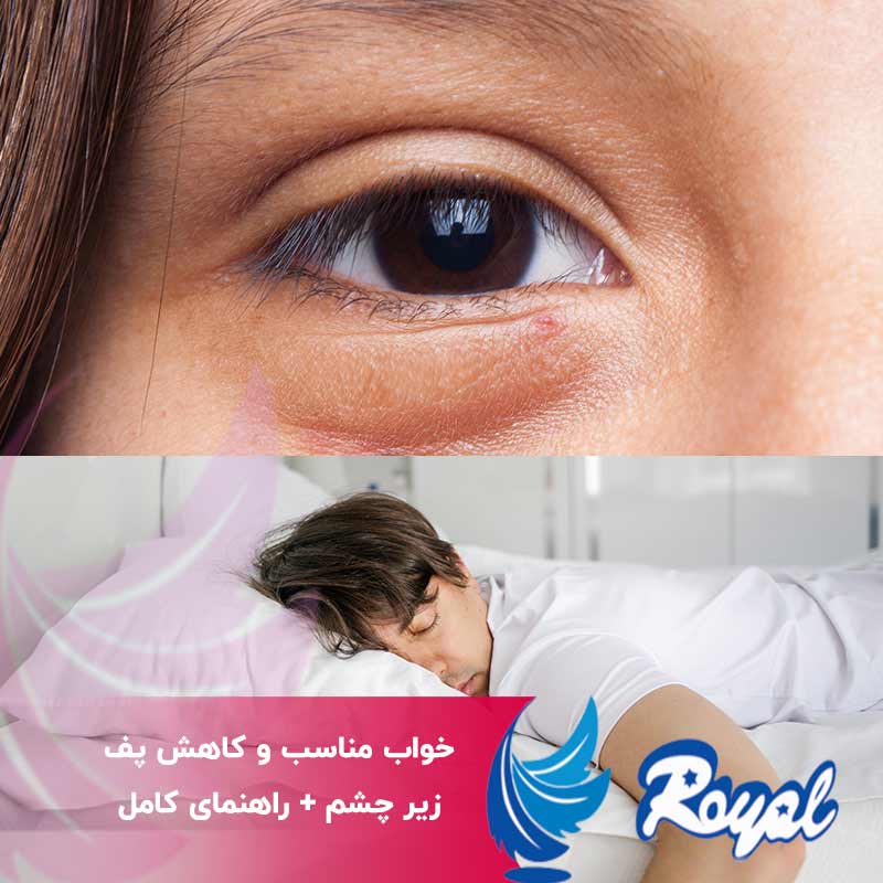 خواب مناسب و کاهش پف زیر چشم
